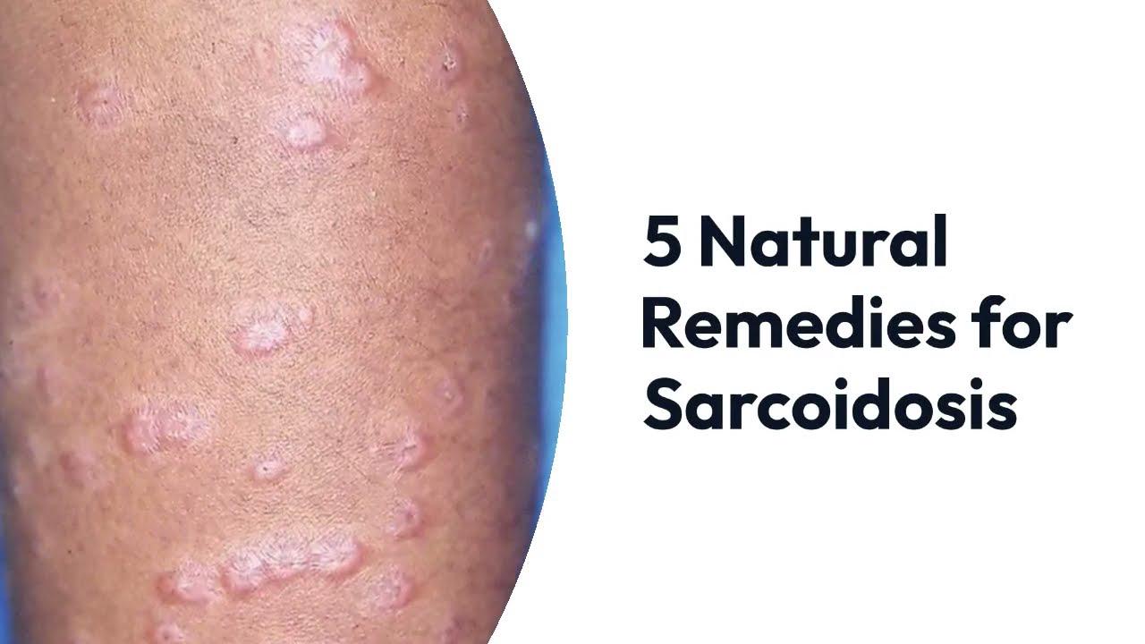 'Video thumbnail for Top 5 Natural Remedies for Sarcoidosis'
