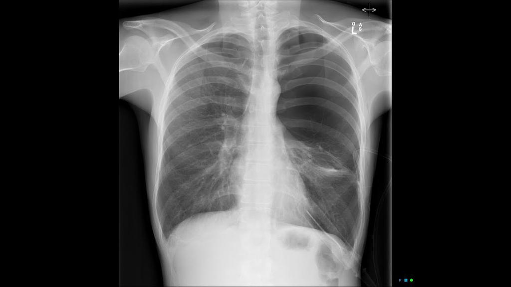 'Video thumbnail for Pneumothorax X-ray | Radiological Diagnosis of Pneumothorax'